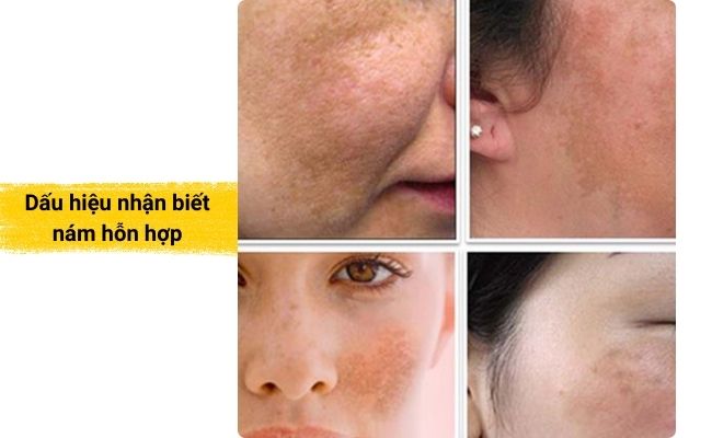 Một số dấu hiệu đặc trưng nám hỗn hợp
