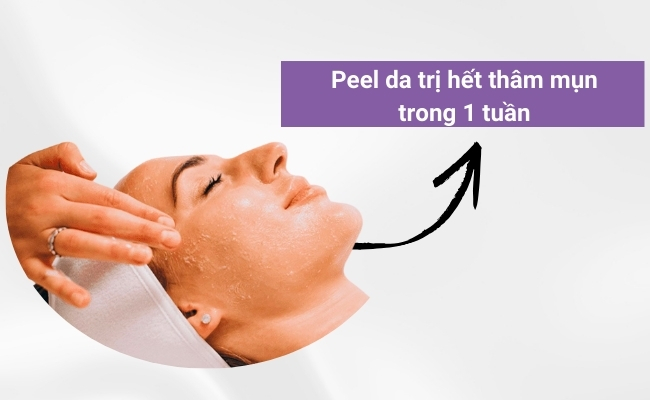 Làn da tươi trẻ, mờ hết thâm mụn chỉ sau 1 tuần với liệu pháp Peel da