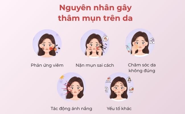 Nguyên nhân gây thâm mụn trên da: rối loạn sắc tố da, nặn mụn sai cách, không dùng kem chống nắng,...