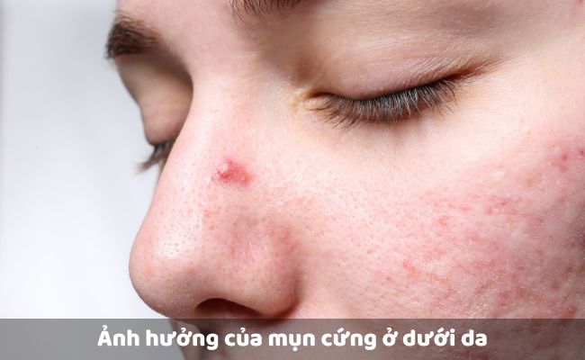 Ảnh hưởng của mụn cứng ở dưới da