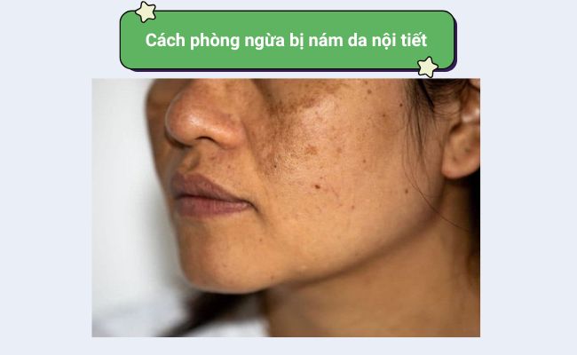 Cách phòng ngừa bị nám da nội tiết
