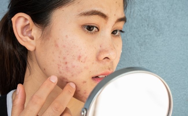 Tác dụng phụ có thể gặp phải khi dùng Retinoid là gì?