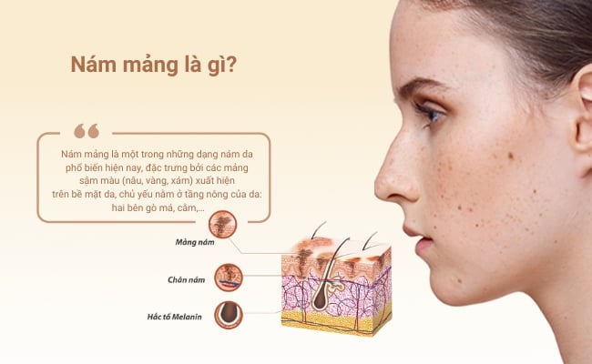 Nám mảng là gì?