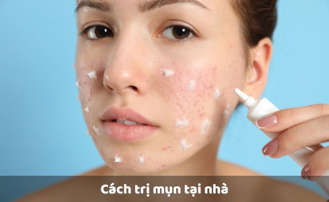 Cách trị mụn tại nhà

