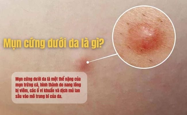 Mụn cứng dưới da là gì? Đặc điểm của mụn chai cứng dưới da