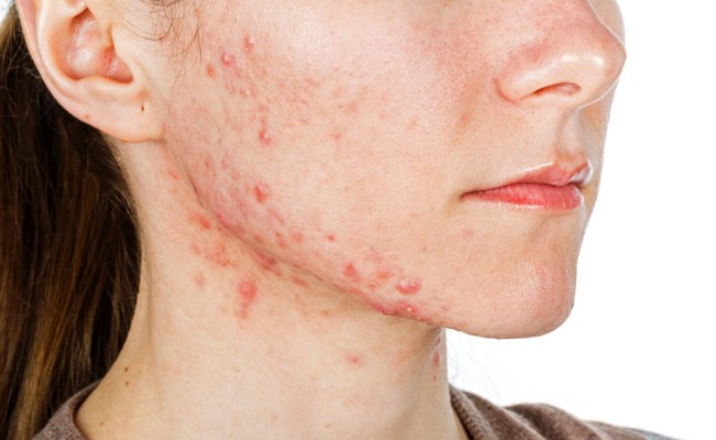 Nguyên nhân gây mụn nội tiết