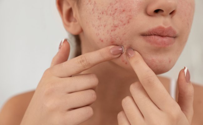 Biến chứng của mụn