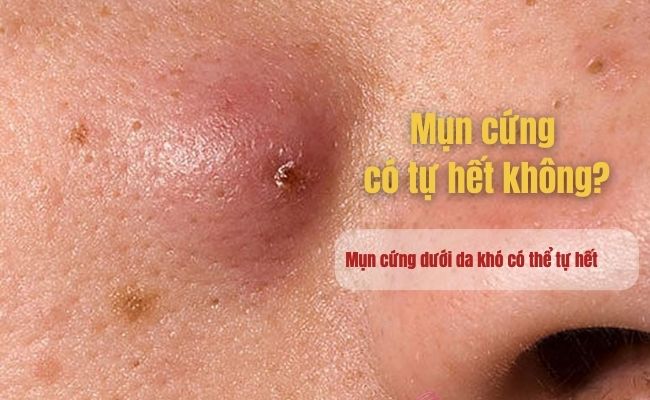 Mụn cứng có tự hết không?