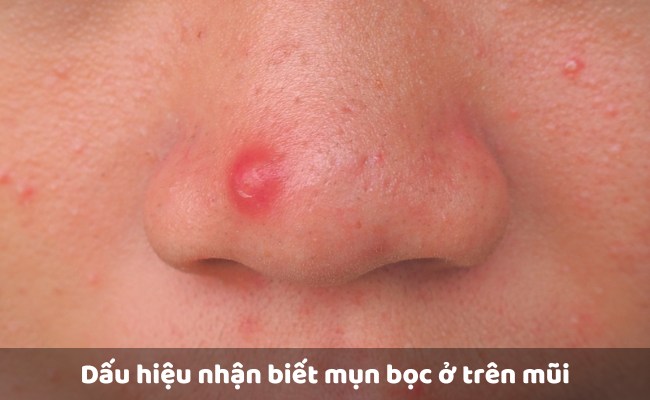 Dấu hiệu nhận biết mụn bọc ở trên mũi