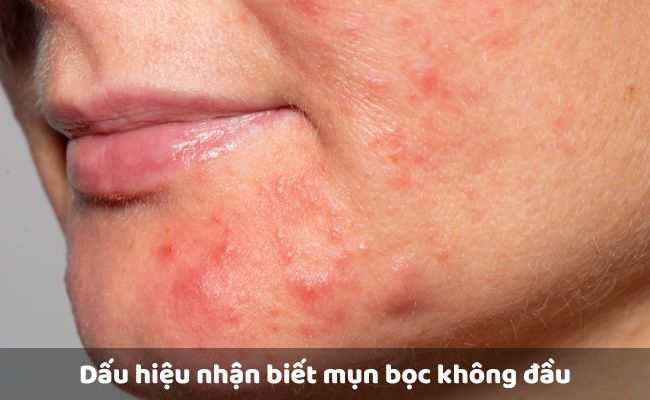 Dấu hiệu nhận biết mụn bọc không đầu