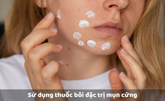 Sử dụng thuốc bôi đặc trị

