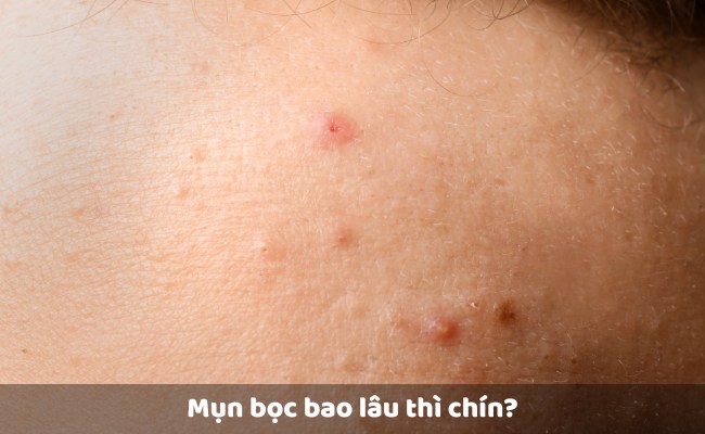 Mụn bọc bao lâu thì chín?