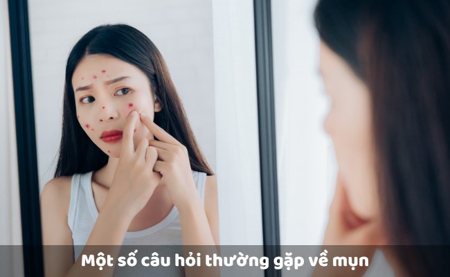 Một số câu hỏi thường gặp về mụn