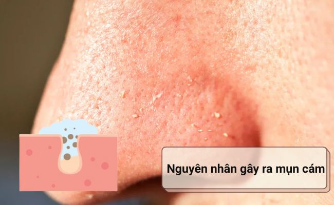Nguyên nhân gây ra mụn cám