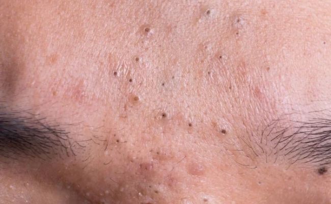 Mụn đầu đen để lâu có sao không?