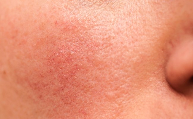 Tác dụng phụ có thể xảy ra khi peel da mặt

