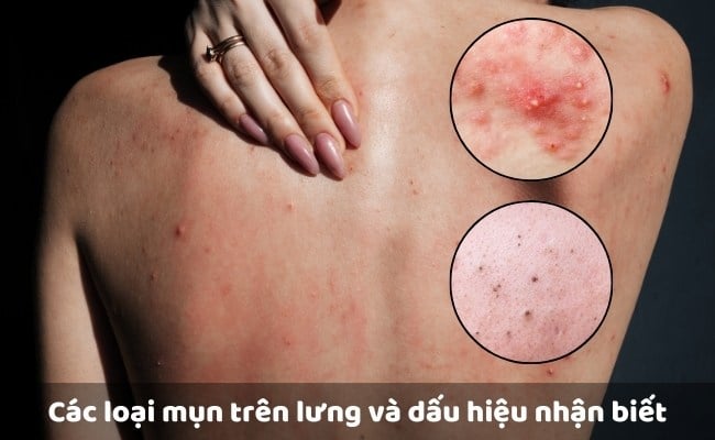 Các loại mụn trên lưng và dấu hiệu nhận biết

