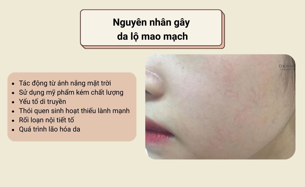 Nguyên nhân gây da lộ mao mạch