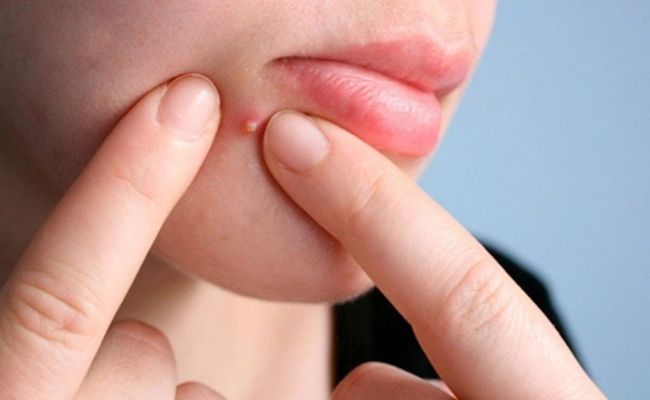 Mụn mủ tuổi dậy thì