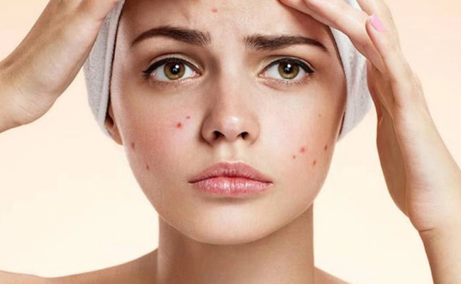 Retinol trị mụn Retinol có trị mụn không?