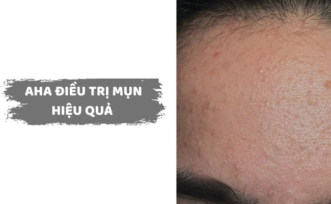 AHA có tác dụng hỗ trợ điều trị mụn