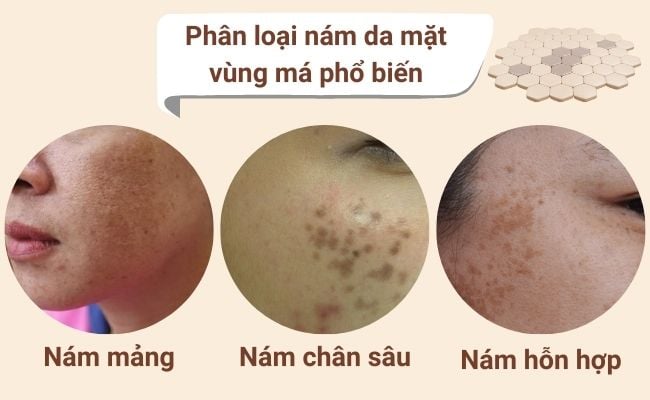 Phân loại nám da mặt vùng má phổ biến