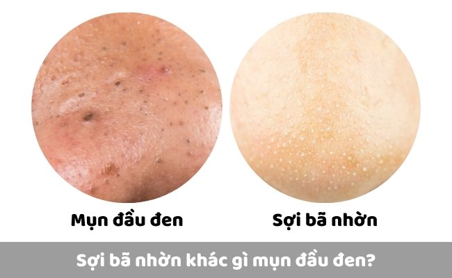 Sợi bã nhờn khác gì mụn đầu đen?