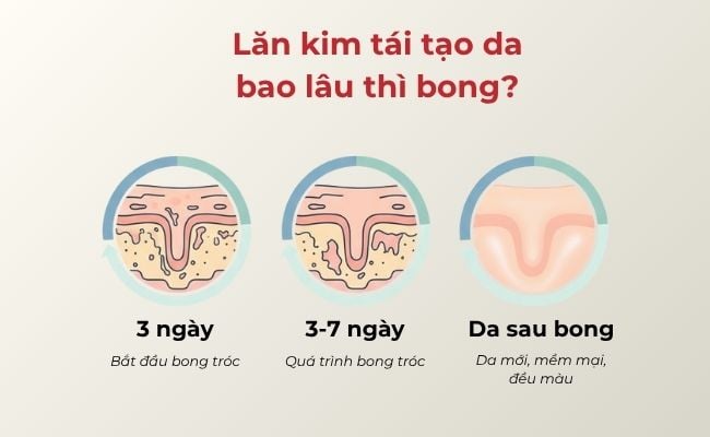 Lăn kim tái tạo da bao lâu thì bong?