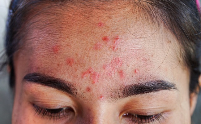 Nguyên nhân dẫn đến mụn dị ứng trên da - dị ứng mỹ phẩm