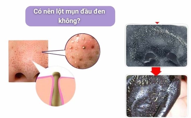 Có nên lột mụn đầu đen không?