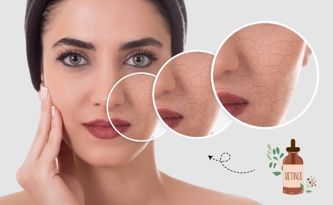 da khô có nên sử dụng retinol không