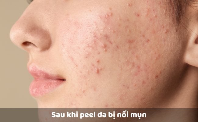 Sau khi peel da bị nổi mụn

