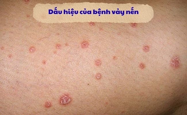 Dấu hiệu của bệnh vảy nến