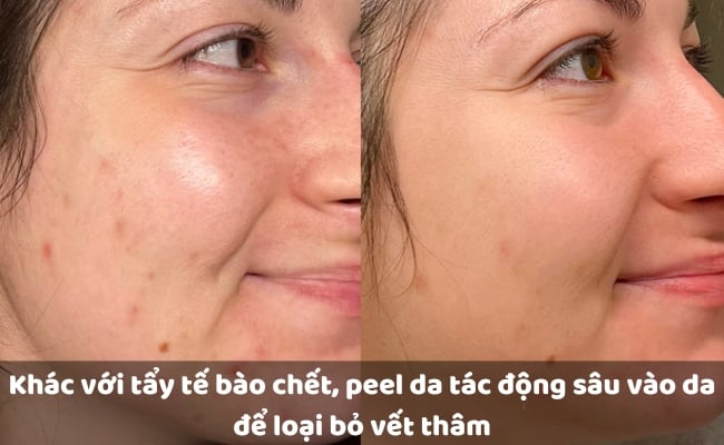 Khác với tẩy tế bào chết, peel da tác động sâu vào da để loại bỏ vết thâm