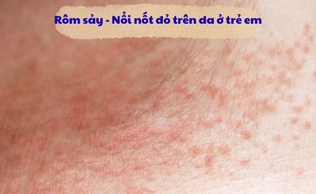 Rôm sảy - Nổi nốt đỏ trên da ở trẻ em