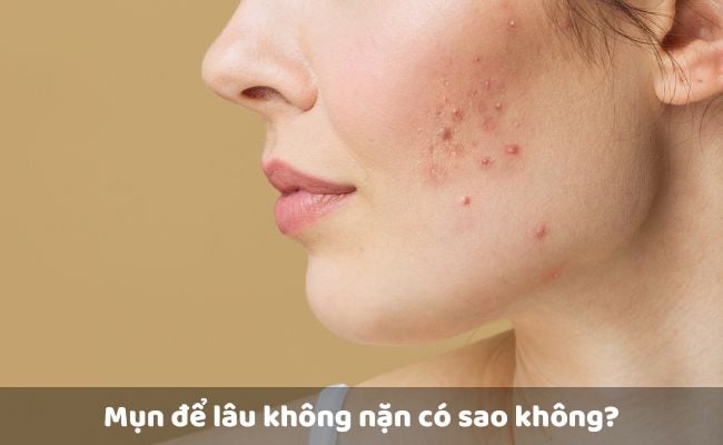 Mụn để lâu không nặn có sao không? Có nên chờ mụn tự khỏi không?