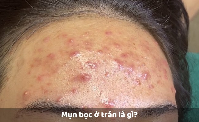 Mụn bọc ở trán là gì?