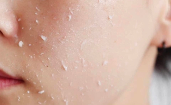 Cách lột mụn đầu đen tại nhà bằng làm sạch da và tẩy tế bào chết đều đặn