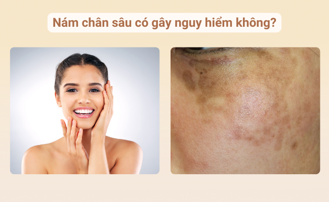 Hình ảnh so sánh làn da khỏe mạnh và làn da bị nám sâu – ảnh hưởng chủ yếu đến thẩm mỹ chứ không nguy hiểm tính mạng.