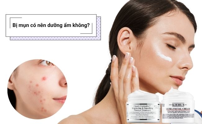 Bị mụn có nên dưỡng ẩm không