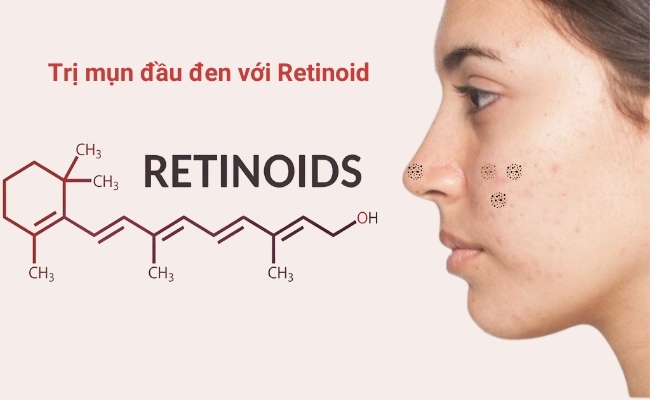 Retinoid tại chỗ điều trị mụn đầu đen