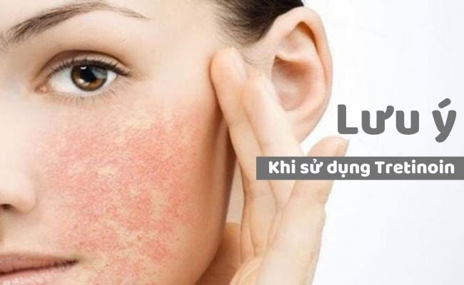 Những điều cần lưu ý khi sử dụng Tretinoin trên da