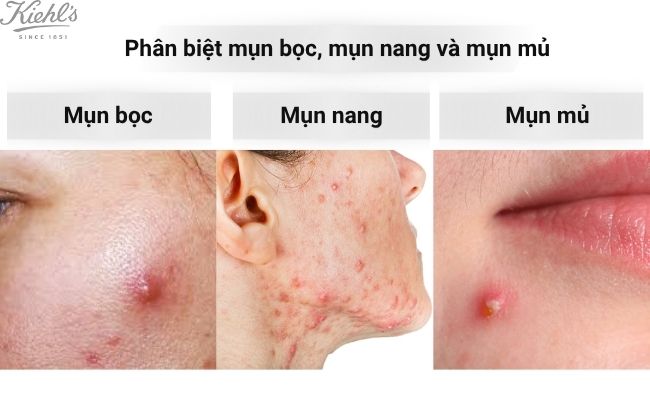 Phân biệt mụn bọc, mụn nang và mụn mủ
