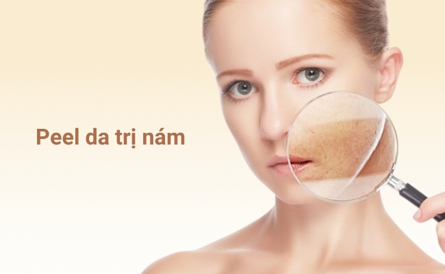 Peel da trị nám là phương pháp khá phổ biến hiện nay