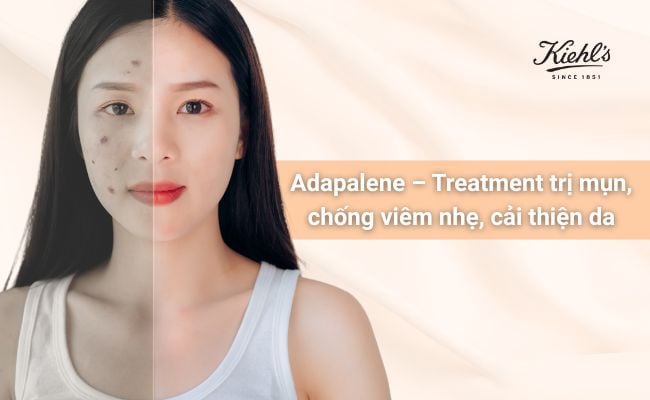 Các loại treatment trị mụn phổ biến, an toàn, hiệu quả
