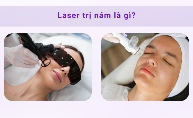 Laser trị nám là phương pháp hiện đại, mang lại hiệu quả cao