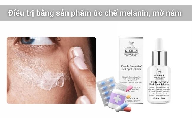 Điều trị các loại nám bằng kem bôi đặc trị