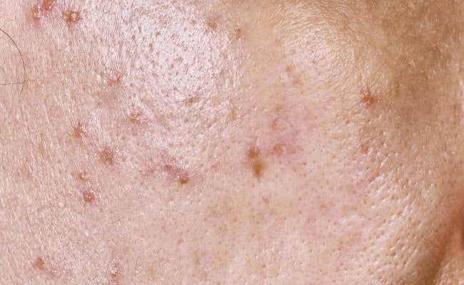 Nổi mụn đỏ trên da là biểu hiện của viêm da tiết bã

