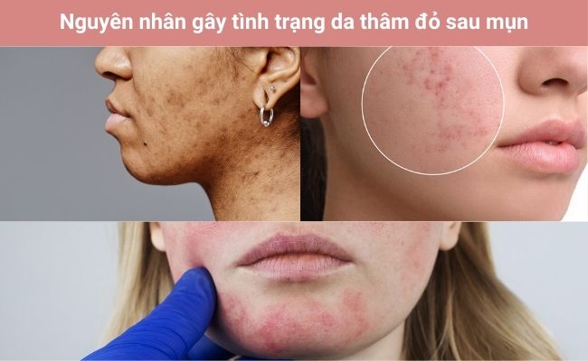 Phân loại các tình trạng thâm đỏ sau mụn thường gặp