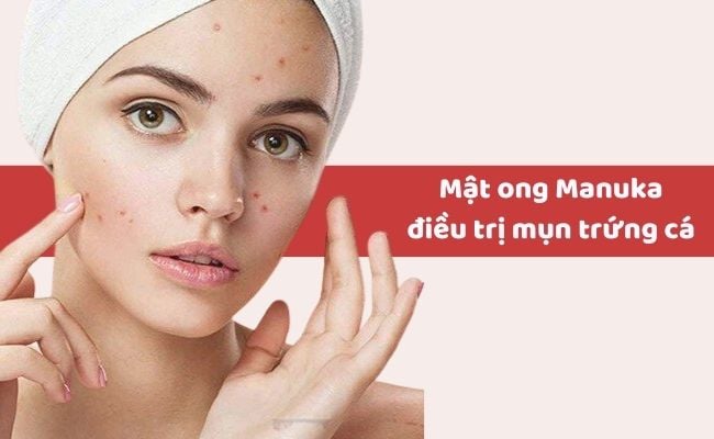 Lợi ích của mật ong Manuka là gì?
